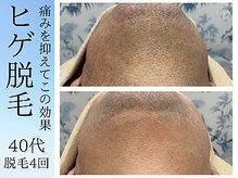 アンジェリーナ/ヒゲ脱毛4回経過