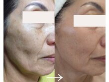 フェイスプラスリフ(FACE+RiF)/たるみケア、シミ、エイジング