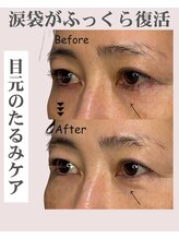 アンジェリカ(Angelica)/涙袋が復活！目のたるみケア