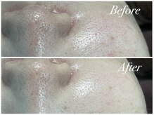 アンドナイン エス店(ANDNINE.)/毛穴洗浄1回