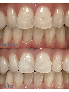 トゥジュール(Toujours)/美容ジェル1回