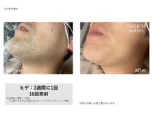 ケーナイン(K-9)/メンズ人気No.1！ヒゲ脱毛