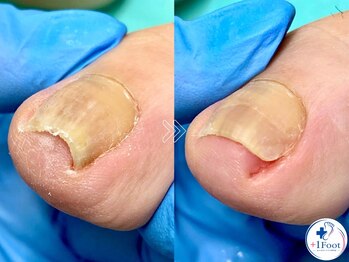 プラスワンフット 本厚木(+1 Foot)/巻き爪矯正は専門店へ