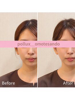 ポルクス鍼灸整骨院 表参道(Pollux鍼灸整骨院)/美容鍼、EMSフェイシャル