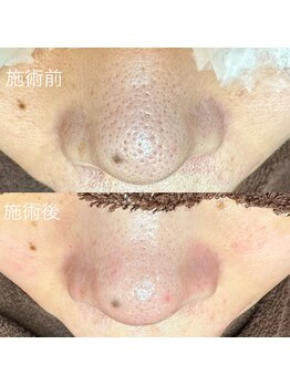 エクラ バイ シャンリィ(eclat by shanLy)/次世代の毛穴ケア