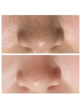 ミレア(Mirea)/サロンで人気の毛穴洗浄ケア♪