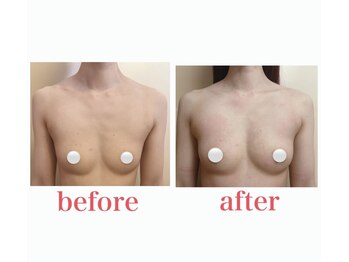 ブロッサム 那覇店/光筋膜バストケア★効果写真