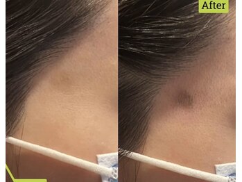 スキンラボ 新宿(@SkinLabo)/プラズマシミケア★右側施術直後