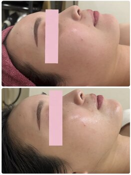 レイビス 仙台店(RAYVIS)/人気の幹細胞導入！