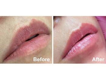 エヴァワックス 大阪 南堀江店(Eva Wax)/ローマピンク/ワックス脱毛