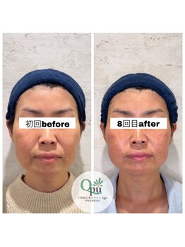 キュープ 相模原淵野辺店(Qpu)/たった4回で人生で1番小さな顔に