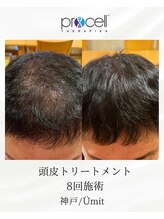 ユミト(Umit)/プロセルスカルプ