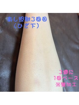 フェリッセ(FELISSE)/あし脱毛 照射3回目【K様】