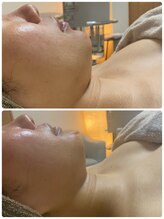 サロン アール(salon R)/ポレーション機器で美容成分を☆