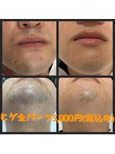 リアンジュ/髭脱毛の経過