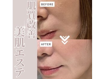 ビンナ 五反田店(Binna)/ハーブピーリング