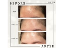 リブ(Lib)/HAABREPRO～ハーブピーリング～