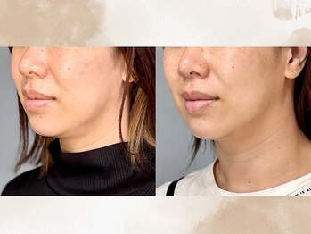 ハス(hasu.)/30代　たるみ改善8回目