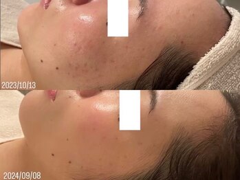 リスト 四日市店(Rist)/肌質改善【Before/After】