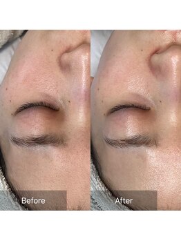 ユーイン 塩尻店(U-in)/ララピールビフォーアフター