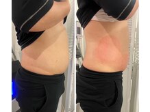 ソフィーム/お腹/脇に箇所脂肪冷却痩身