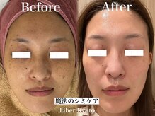 リベルキョウト 京都駅前店(Liber Kyoto)/魔法のシミケア