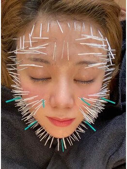 プレシャスワン 越谷店/美容鍼(300本)