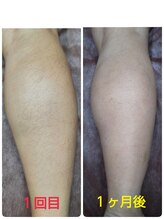 ヒーリングデトックス リラックリ(HealingDetox RELUCKRY)/ひざ下脱毛★経過途中写真