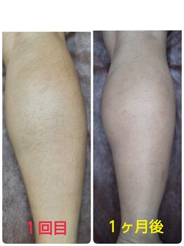 ヒーリングデトックス リラックリ(HealingDetox RELUCKRY)/ひざ下脱毛★経過途中写真