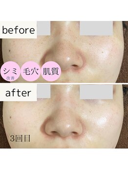 ユーエムスタイル(UMStyle)/超音波リフト★水玉リフティング