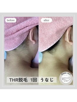 カラー(CALLA)/うなじ脱毛
