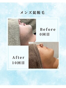 エデン つくば店(EDEN)/メンズ髭脱毛