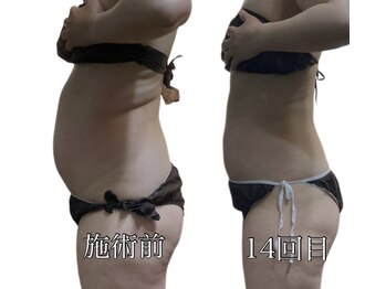 エリクシア 松戸/50代の方ウエスト集中リンパ痩身