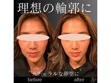 チョコバリ 郡山店(chocobari)/小顔×リフトアップ(美容鍼)20代