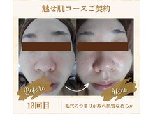 ソフィアパレス 西葛西店/魅せ肌コースNo1