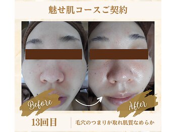 ソフィアパレス 西葛西店/魅せ肌コースNo1