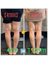 クシロ鍼灸整骨院/【O脚矯正】施術例