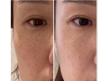 アンシャンテ(Anchant)/【ダクトピール（水光肌）】