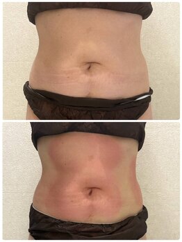 リアウェイク(Reawayke)/脂肪冷却1回目の効果