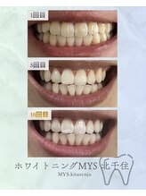 ホワイトニングミース 北千住店(MYS)/当店の通い放題のご利用結果１