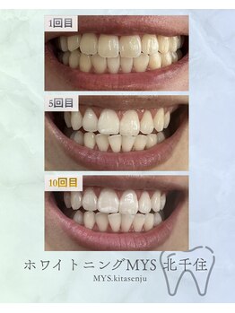ホワイトニングミース 北千住店(MYS)/当店の通い放題のご利用結果1