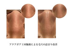 ピービー(PB)/毛穴洗浄