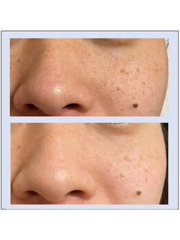 シュシュレ 博多(ShushuLe)/20代１回/毛穴ケア・シミケア