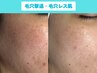 【毛穴撃退】黒ずみ＆角栓も改善で毛穴レス肌へ★90分15,800円