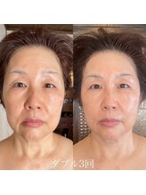 小顔フェイスラボ 鈴鹿店(小顔FaceLabo.)/◆たるみ改善◆