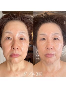 小顔フェイスラボ 鈴鹿店(小顔FaceLabo.)/◆たるみ改善◆
