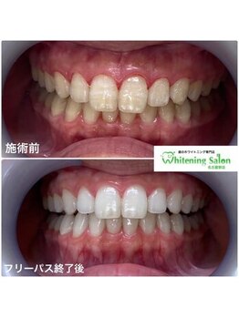 ホワイトニングサロン 名古屋駅店/【ホワイトニング施術例】
