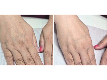 手の光エステ/本格シミしわケア