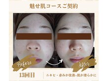 ソフィアパレス 西葛西店/魅せ肌コースNo2