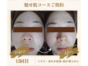 ソフィアパレス 西葛西店/魅せ肌コースNo2